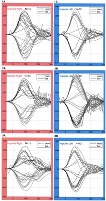 Refixation Saccades with Normal Gain Values: A Diagnostic Problem in the Video Head Impulse Test: A Case Report